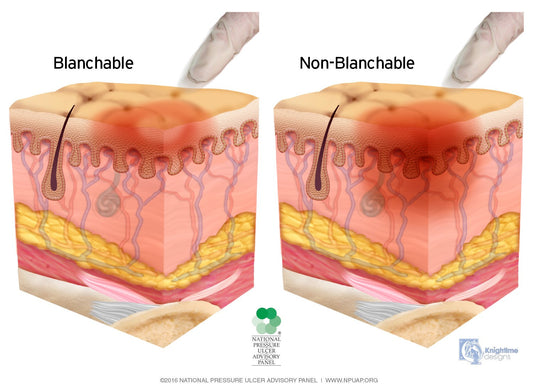 PRESSURE INJURY -- It's the New Pressure Ulcer
